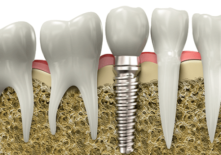 Ottawa Dentist, Dental Implants