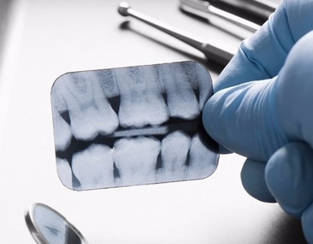 Preventative Oral Hygiene & Cleanings, Ottawa Dentist